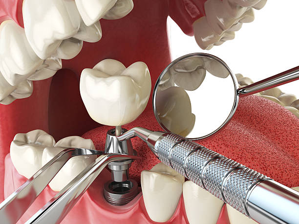 Best Emergency Dental Care for Broken or Chipped Teeth in Marion Oaks, FL